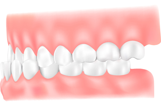 反対咬合（受け口）